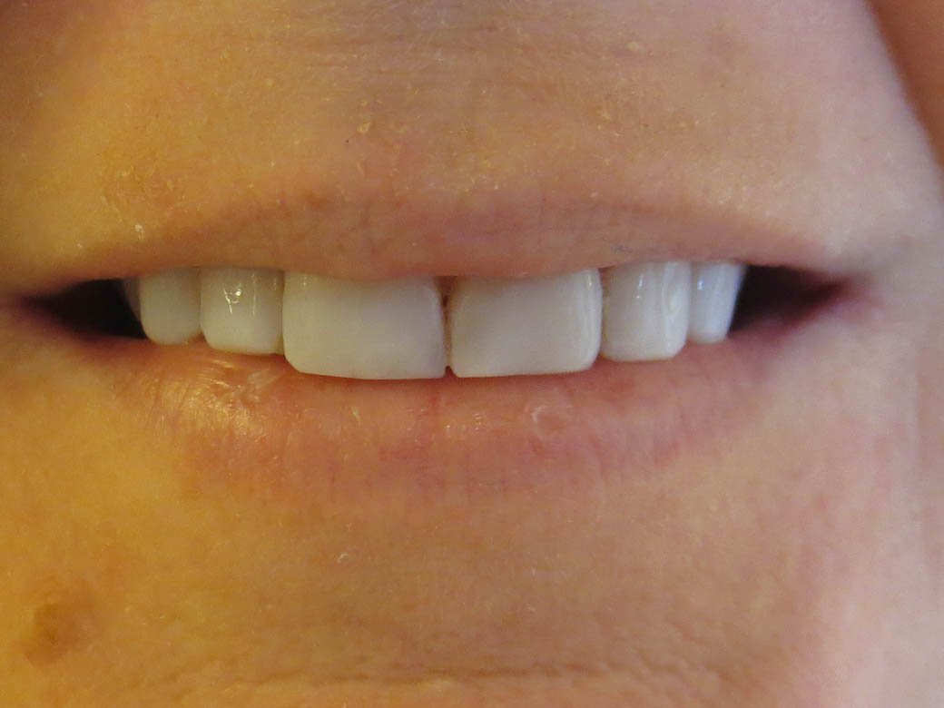 Front Teeth Crowns After